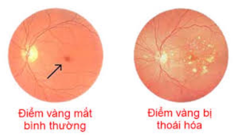 So sánh giữa mắt bình thường và mắt bị thoái hóa điểm vàng. Nguồn: Báo sức khỏe và đời sống.