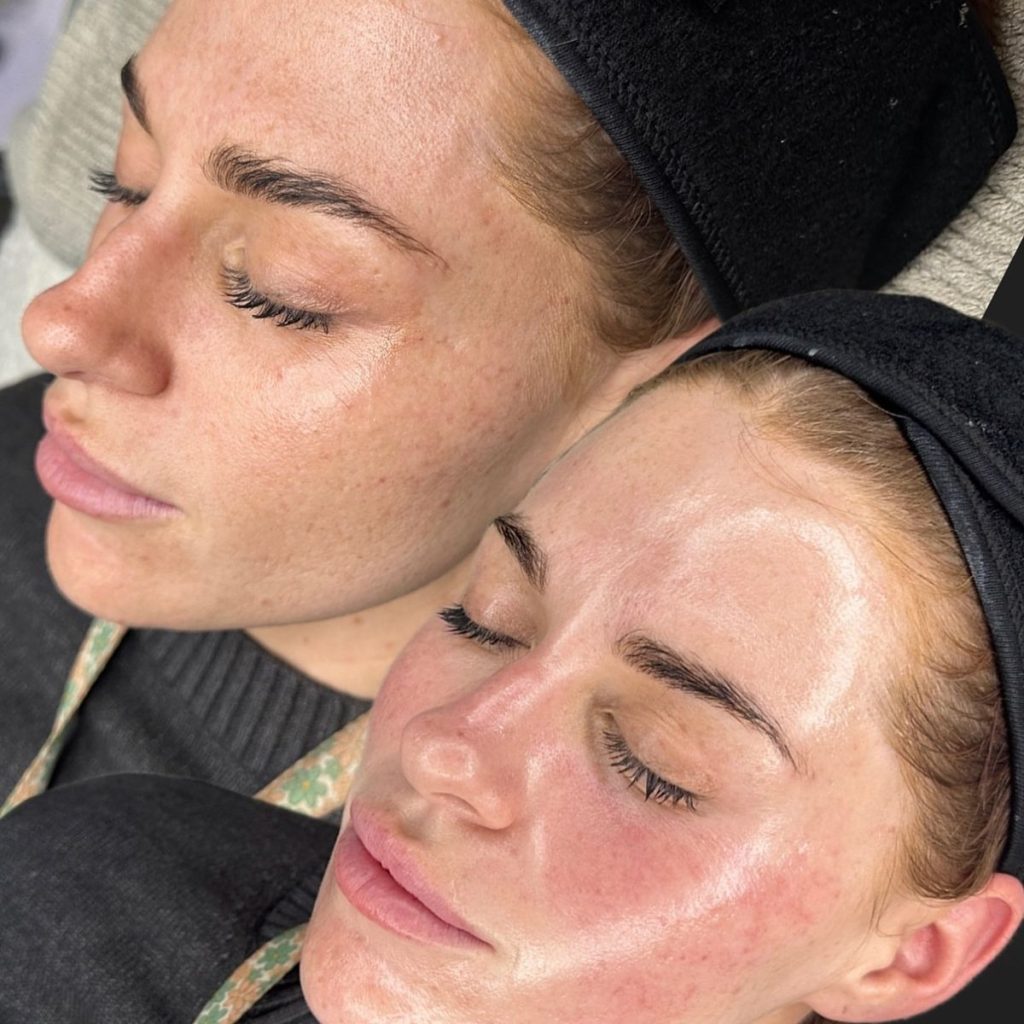 Da đang treatment thường gặp tình trạng đỏ rát và nhạy cảm cực độ với ánh nắng mặt trời. Ảnh: internet.